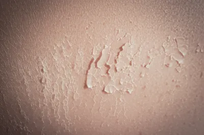 Illustration pityriasis