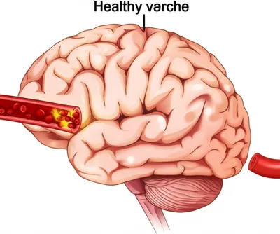 Illustration stroke - Image 1