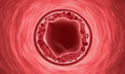 Illustration embolism