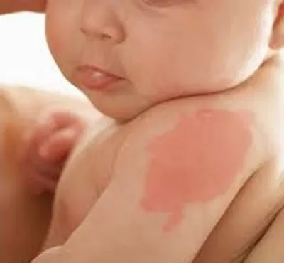 Illustration birthmark - Image 2