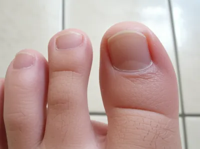 Illustration toenail - Image 1