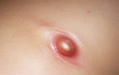 Illustration boil - Image 1