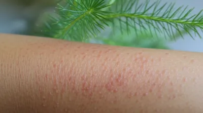 Illustration nettles - Image 1