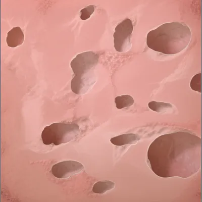 Illustration cavitation - Image 1