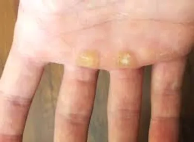 Illustration callous - Image 2