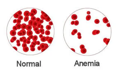 Illustration anemia - Image 2