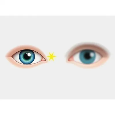 Illustration amblyopia