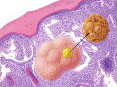 Illustration tumors - Image 1