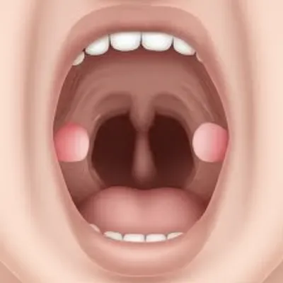 Illustration tonsil - Image 1