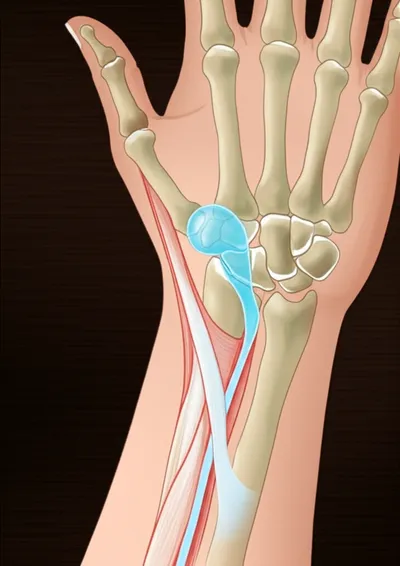 Illustration ganglion - Image 1