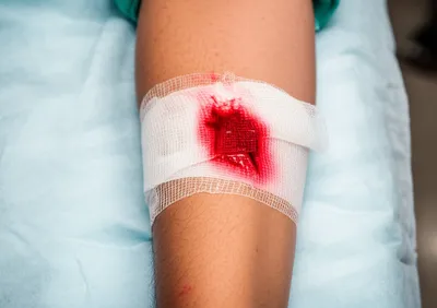 Illustration haemorrhage - Image 1