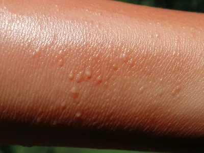 Illustration blistering - Image 1