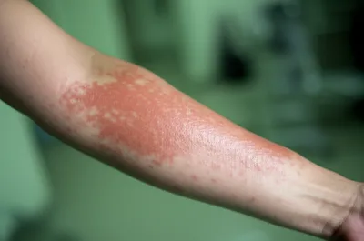 Illustration outbreaks