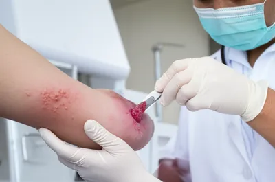 Illustration lancing - Image 1