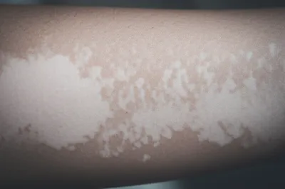 Illustration bleaches - Image 1