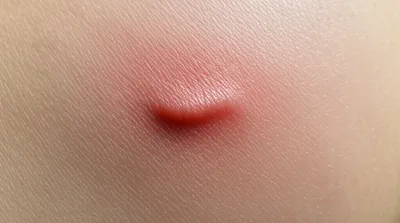 Illustration welts - Image 1