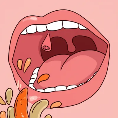 Illustration uvula - Image 1