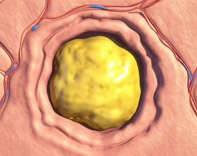 Illustration abscess - Image 1