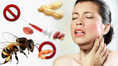 Illustration anaphylaxis - Image 1