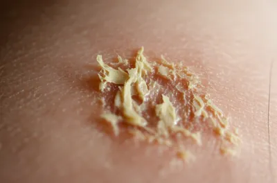 Illustration sloughs - Image 1