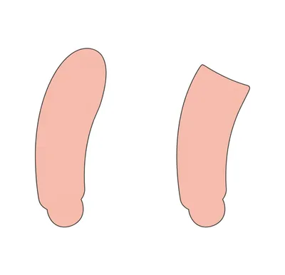 Illustration foreskin - Image 1