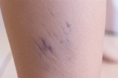 Illustration varices