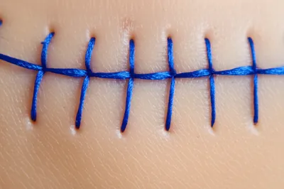 Illustration sutured - Image 1