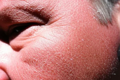 Illustration actinic - Image 1