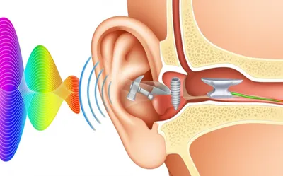 Illustration tympanum - Image 1