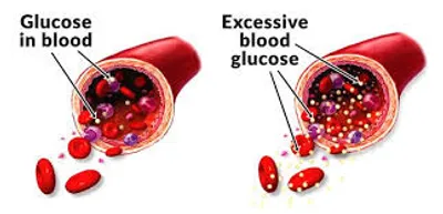 Illustration diabetes - Image 2