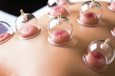 Illustration cupping