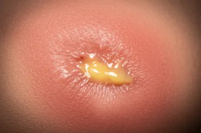 Illustration suppurating