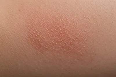 Illustration dermatitis