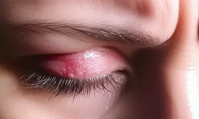 Illustration irritate