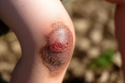 Illustration scabbed - Image 1