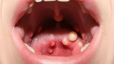 Illustration angina - Image 1