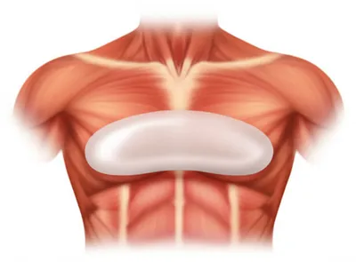 Illustration implant