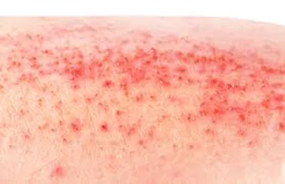 Illustration rash - Image 2