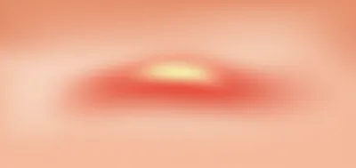 Illustration pimple - Image 1