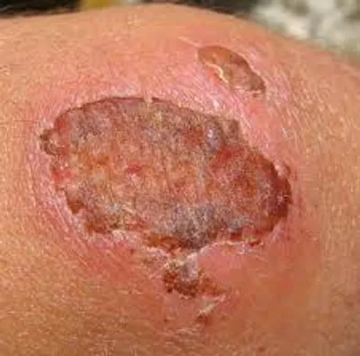 Illustration scab - Image 2