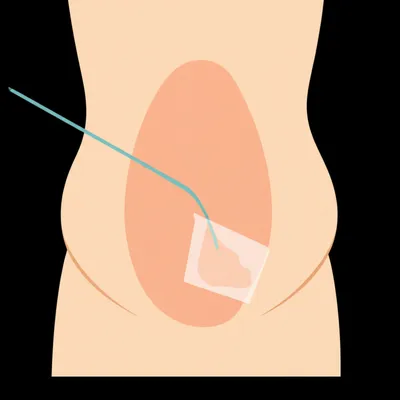 Illustration liposuction - Image 1