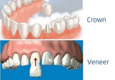 Illustration veneer - Image 2