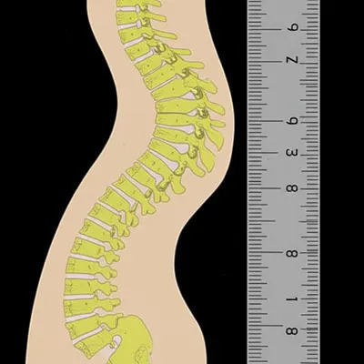 Illustration scoliosis