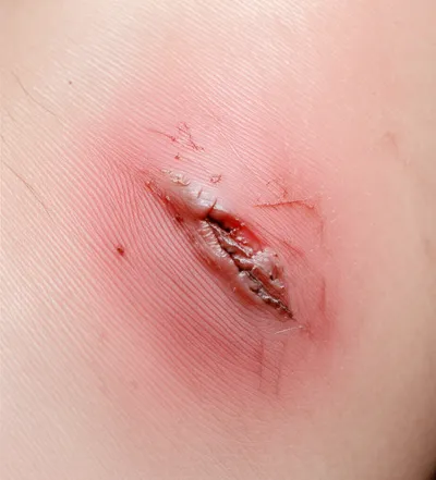 Illustration lesions - Image 1