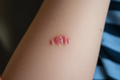 Illustration bite - Image 1