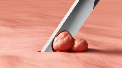 Illustration excision - Image 1