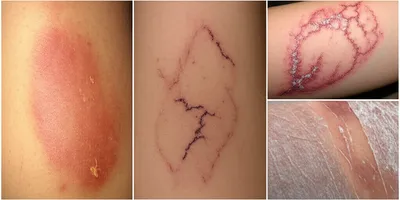 Illustration burn - Image 1