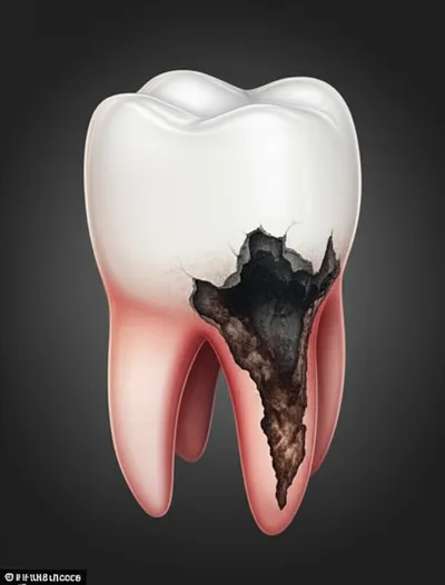 Illustration caries