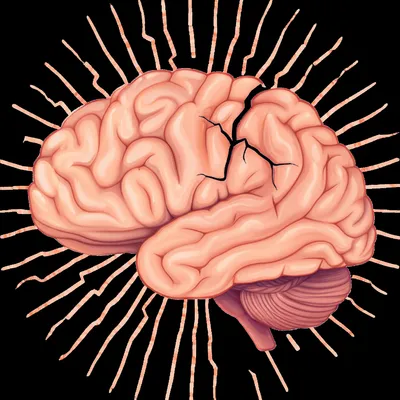 Illustration concussion - Image 1
