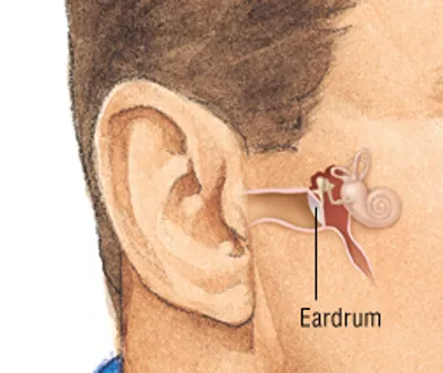 Illustration eardrum - Image 2